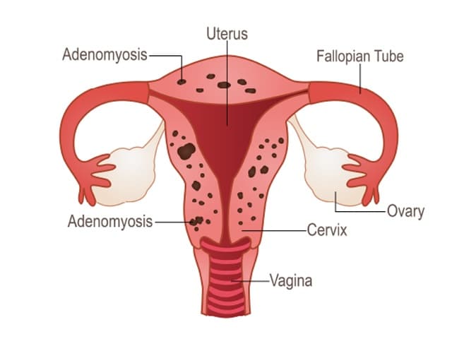 Ovarian Cyst Treatment at Phular IVF