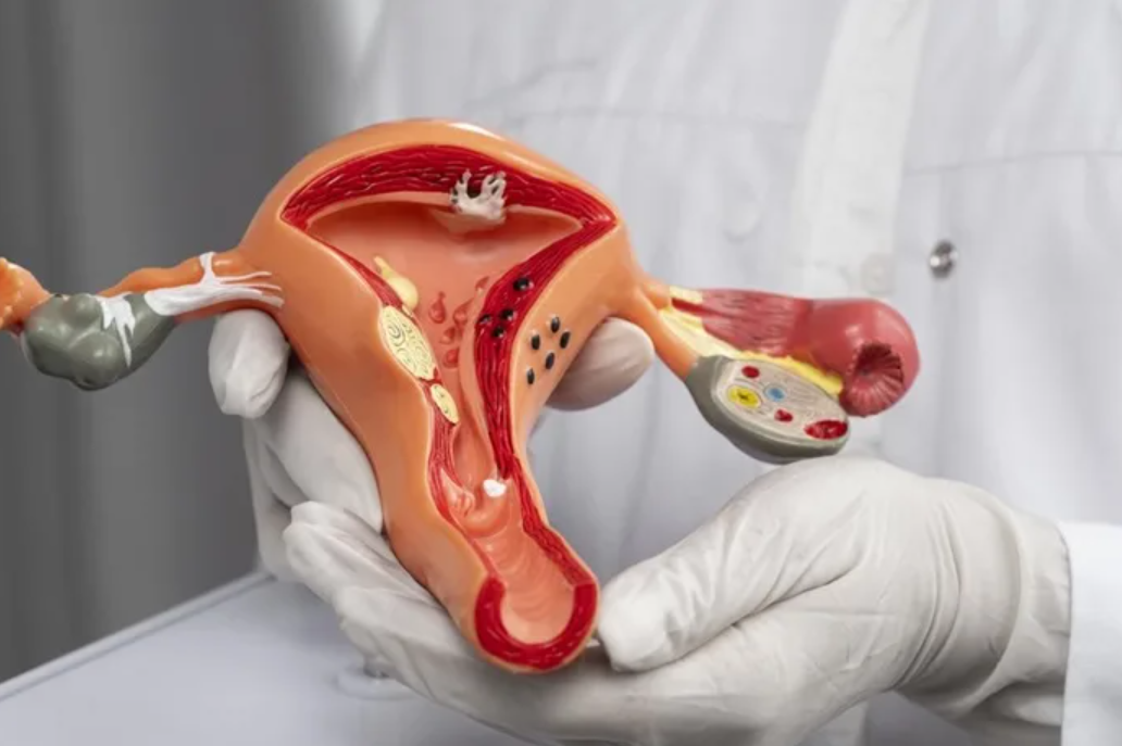 Ovarian Cyst Treatment at Phular IVF