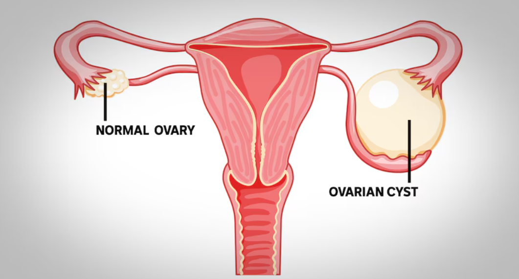 Ovarian Cyst Treatment at Phular IVF