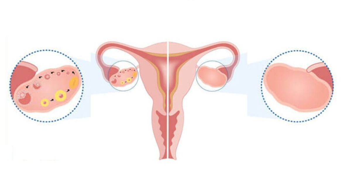 Premature Ovarian Failure Treatment at Phular IVF