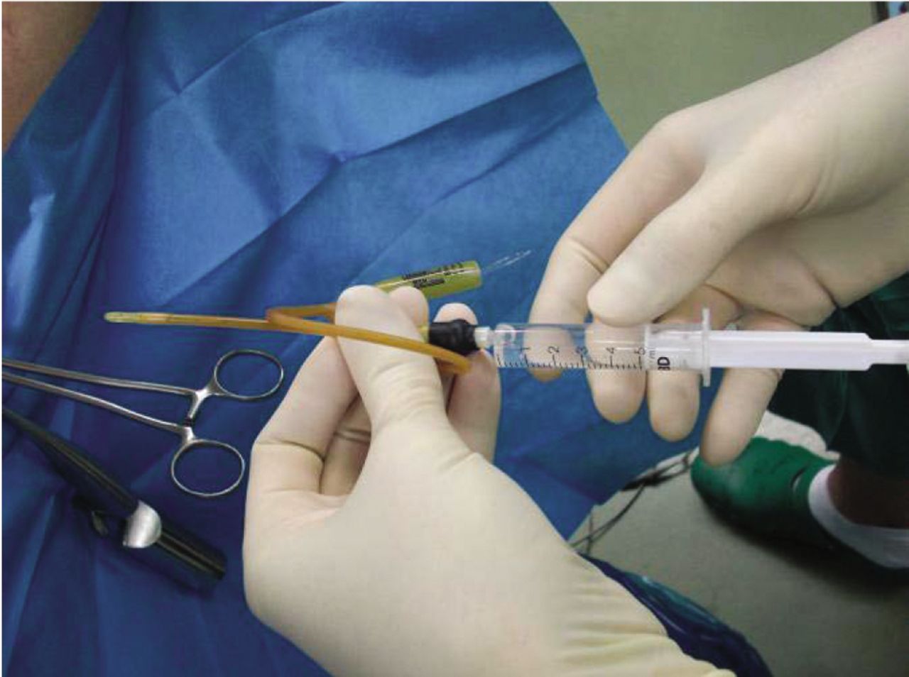 Chromopertubation Test