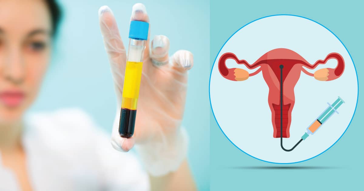 PRP Treatment in IVF