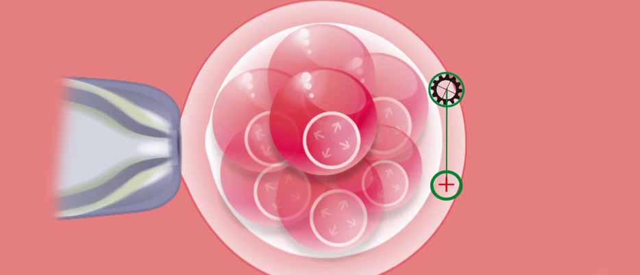 Laser Assisted Hatching IVF