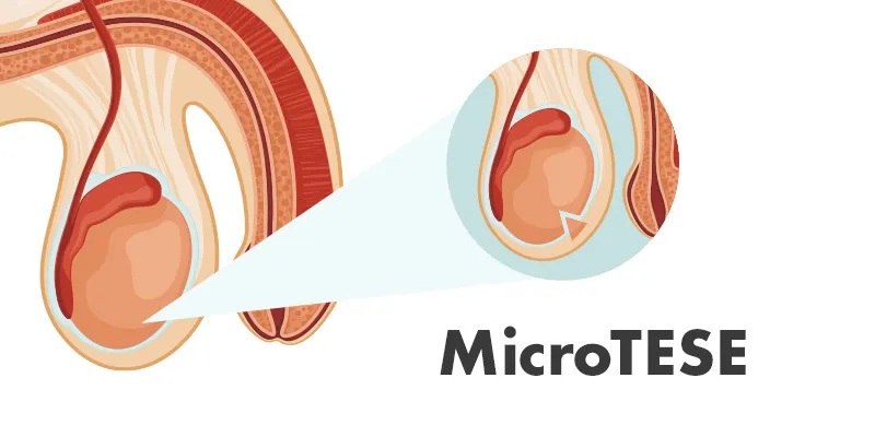 Micro-TESE Procedure
